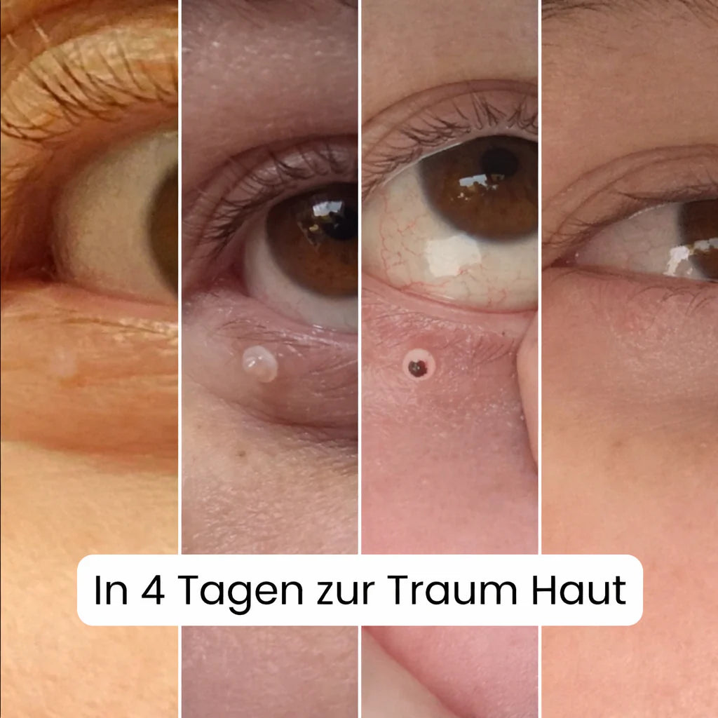 SkinClear™ – Hautmaken Entferner Warzen Mole Komfort Set