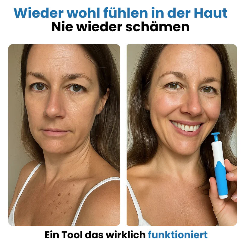 SkinClear™ – Hautmaken Entferner Warzen Mole Komfort Set