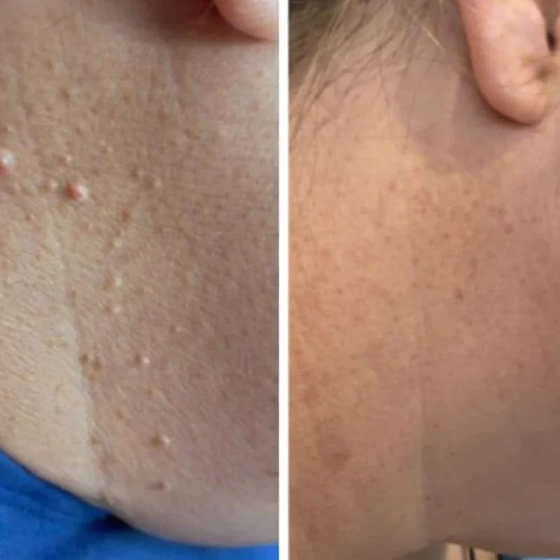 SkinClear™ – Hautmaken Entferner Warzen Mole Komfort Set