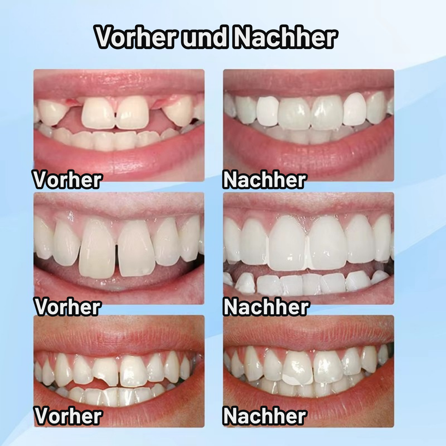 SmileFix™ - Natürlich Aussehendes Zahne Reparaturset (1+1 Gratis)